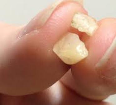 Criança de dois anos engole pedra de crack e é socorrida pelo SAMU, em Janiópolis