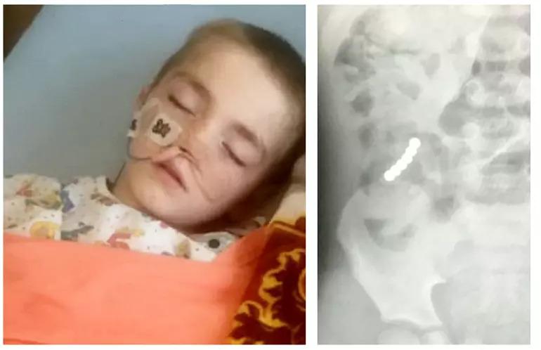 Menino tem intestino perfurado após engolir ímãs de brinquedos populares nas redes sociais