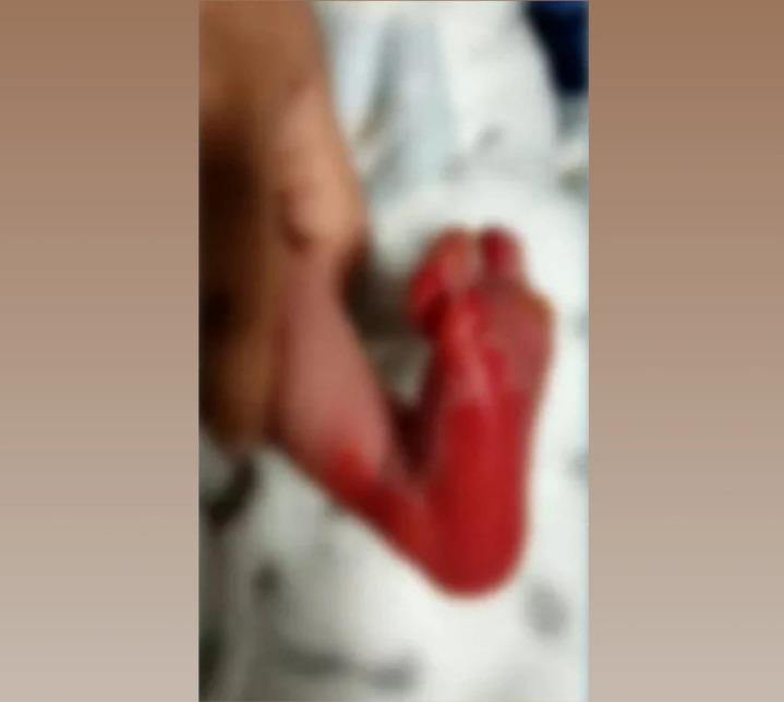 Recém-nascido sofre queimadura grave ao fazer teste do pezinho, em Curitiba