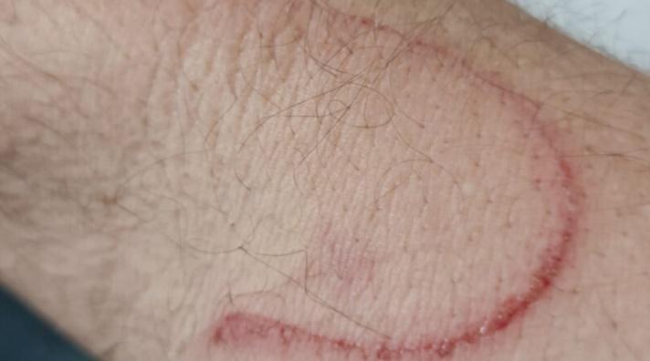 RADIALISTA QUE SUSPOSTAMENTE SOFREU AGRESSÃO TER APANHADO DE CINTA DE POLICIAL E AFIRMA QUE FOI FERIDO EM UM DOS BRAÇOS