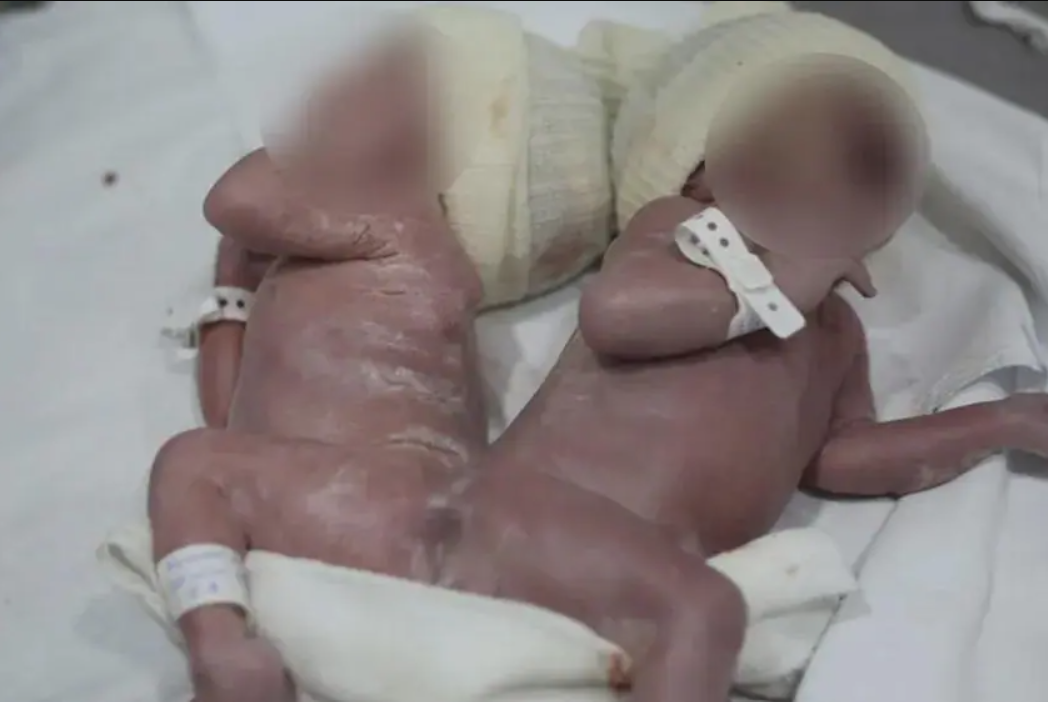 Caso raro - Gêmeos nascem unidos por osso da coluna no Paraná