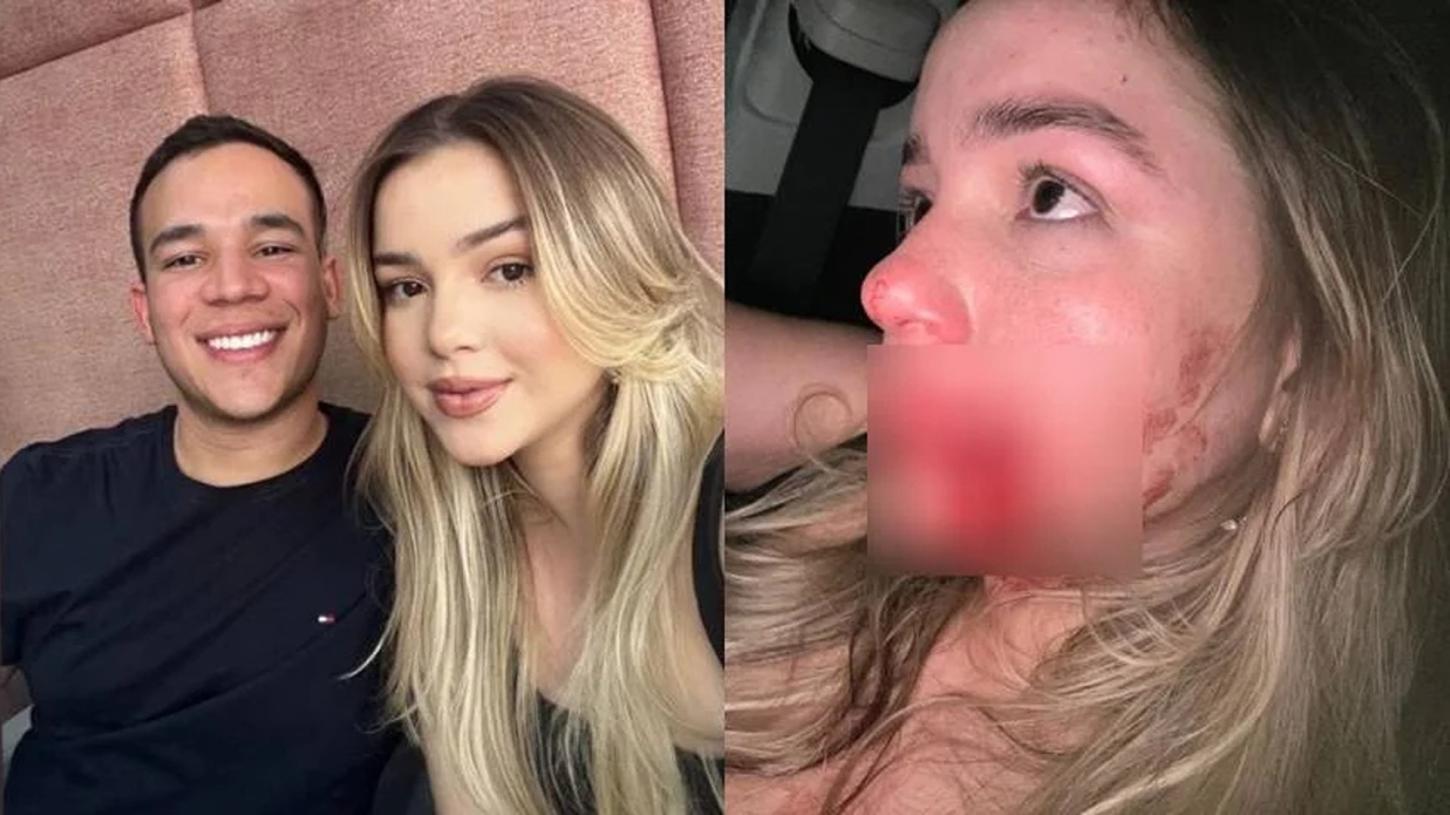 COVARDIA - Modelo leva soco de síndico e fica com buraco no rosto