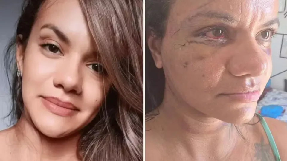 Mulher agredida com 61 socos por ex-jogador mostra o rosto dias após cirurgia
