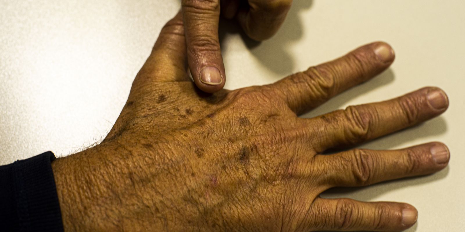 Falhas em dados sobre câncer de pele prejudicam diagnósticos, aponta fundação