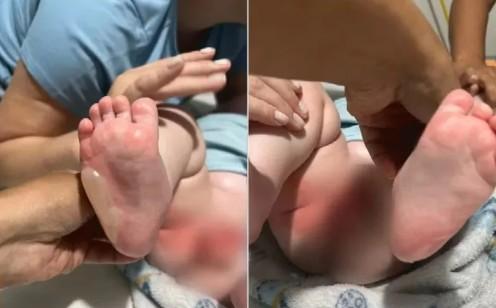 TRAGÉDIA EM RIO VERDE: Bebê de 7 meses sofre queimaduras graves em berçário no primeiro dia de trabalho da mãe